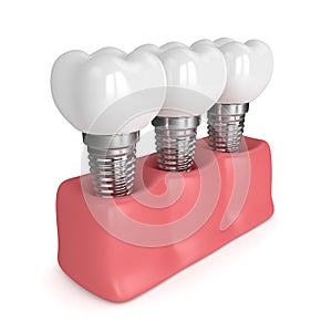 3d render of dental implants in gums