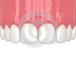 3d render of diastema closure using bonding procedure