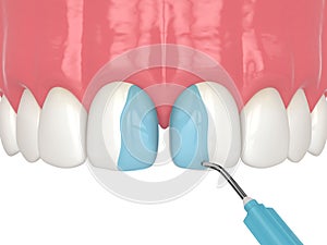 3d render of etching the enamel with a mild acid as a part of bonding procedure