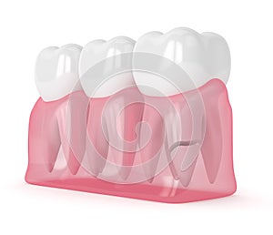 3d render of gums with cracked tooth root