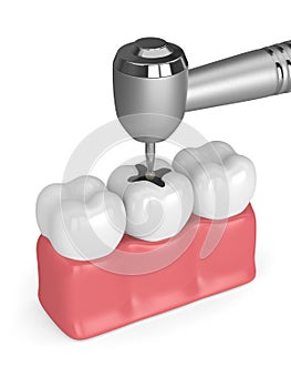 3d render of gums with dental handpiece and drill