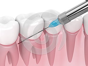 3d render of gums and syringe with dental anesthesia