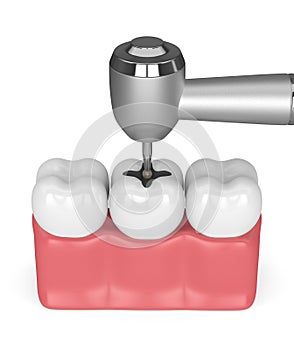 3d render of gums with teeth, dental handpiece and drill