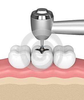 3d render of gums with teeth, dental handpiece and drill