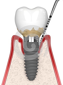 3d render of human gums cross-section with peri implantitis disease and periodontal sonda