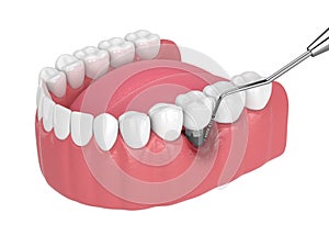 3d render of human jaw with peri implantitis disease and periodontal sonda