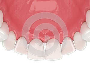 3d render of human upper jaw with black triangles