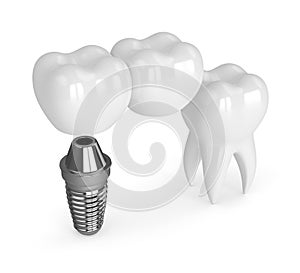 3d render of implant with dental cantilever bridge