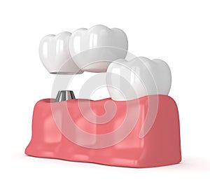 3d render of implant with dental cantilever bridge