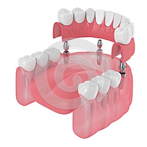 3d render of implant partial denture