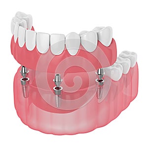 3d render of implant partial denture