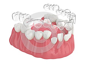 3d render of jaw with clear aligner splint