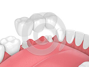 3d render of jaw with dental bridge