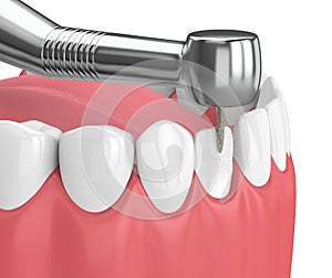 3d render of jaw with dental handpiece and drill