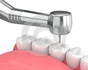 3d render of jaw with dental handpiece and drill