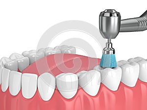 3d render of jaw with dental handpiece and polishing brush