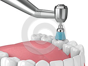 3d render of jaw with dental handpiece and polishing brush