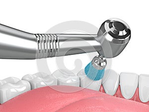 3d render of jaw with dental handpiece and polishing brush