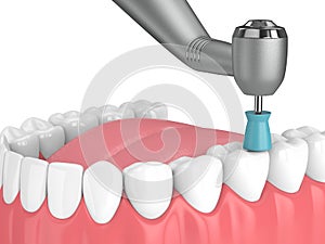 3d render of jaw with dental handpiece and polishing prophy cup