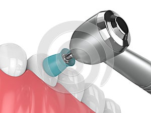 3d render of jaw with dental handpiece and polishing prophy cup