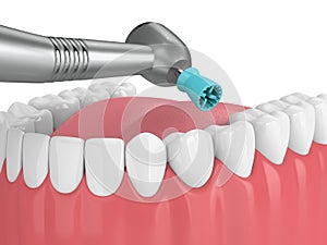 3d render of jaw with dental handpiece and polishing prophy cup