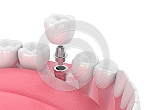 3d render of jaw with dental implant