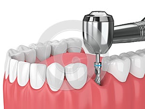 3d render of jaw with dental implant drill