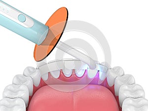 3d render of jaw with dental polymerization lamp and dental fiber