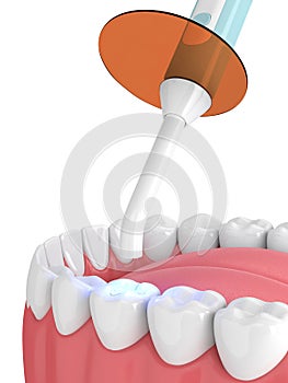 3d render of jaw with dental polymerization lamp and light cured inlay