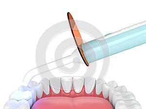 3d render of jaw with dental polymerization lamp and light cured onlay