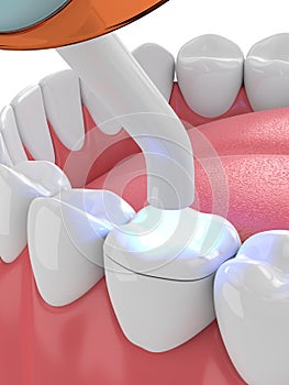 3d render of jaw with dental polymerization lamp and light cured onlay