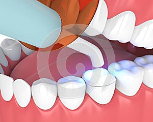 3d render of jaw with dental polymerization lamp and light cured onlay