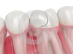 3d render of jaw with fractured tooth