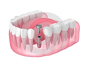 3d render of jaw with implant screw and healing cap