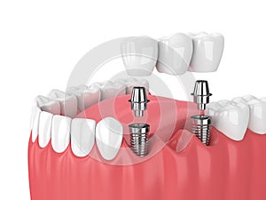 3d render of jaw and implants with dental bridge