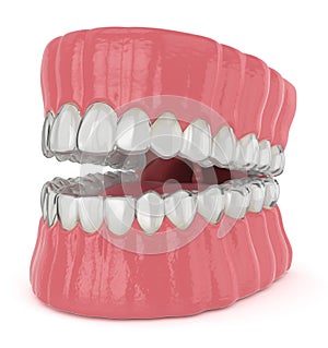 3d render of jaw with invisalign removable retainers