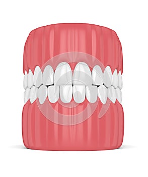 3d render of jaw malocclusion with underbite