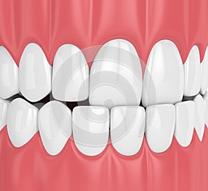 3d render of jaw malocclusion with underbite