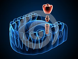 3d render of jaw x-ray  with dental implant placement