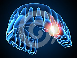 3d render of  jaw x-ray with throbbing toothache