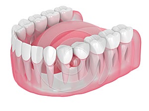 3d render of jaw and teeth with cyst