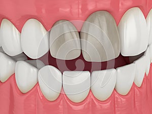 3d render of jaw and teeth with dead pulp