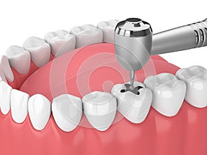 3d render of jaw with teeth, dental handpiece and drill