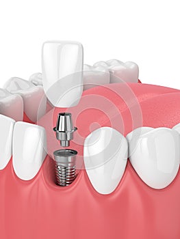 3d render of jaw with teeth and dental incisor implant