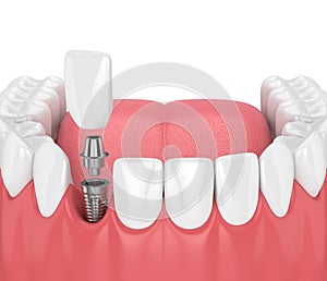 3d render of jaw with teeth and dental incisor implant