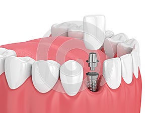 3d render of jaw with teeth and dental incisor implant
