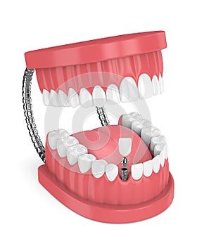 3d render of jaw with teeth and dental incisor implant