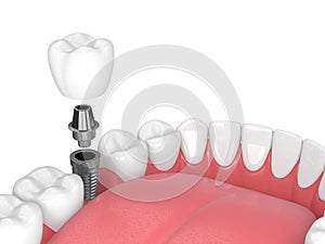 3d render of jaw with teeth and dental molar implant