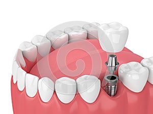 3d render of jaw with teeth and dental molar implant