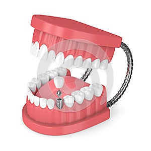 3d render of jaw with teeth and dental premolar implant